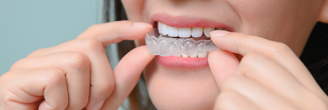 Quels sont les inconvénients d'une gouttière dentaire ?