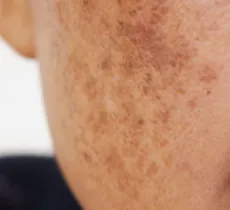 COMMENT ÉVITER LES TACHES BRUNES SUR LE VISAGE ? 