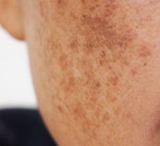 COMMENT ÉVITER LES TACHES BRUNES SUR LE VISAGE ? 