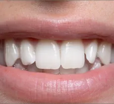 COMMENT ÉVITER ET ÉLIMINER LES TACHES BRUNES SUR LES DENTS ? 