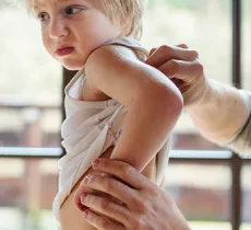 QUELLES SONT LES CAUSES DE L’ECZÉMA ? 