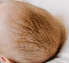 CROÛTES DE LAIT : CAUSES, SOINS, PRÉCAUTIONS... ON VOUS DIT TOUT ! 