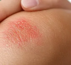 COMMENT CALMER UNE IRRITATION CUTANÉE ? 