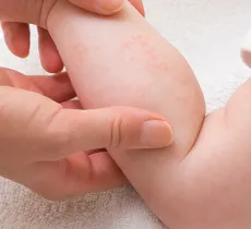 PEAU DE BÉBÉ : COMMENT PRÉVENIR L'ECZÉMA DU NOURRISSON ? 