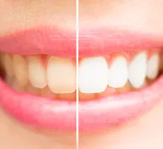 Comment soigner des dents tachées par la nicotine ?