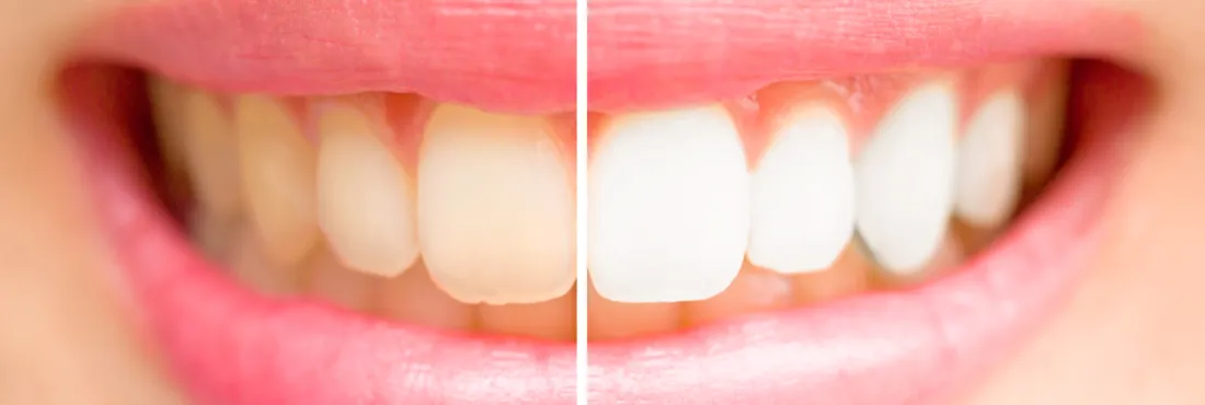 Blanchiment des dents taches par la nicotine - La Belle Adresse